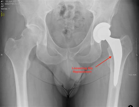 Revision Hip Surgery – Knee and Hip Website