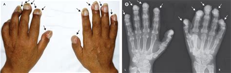 Calcified Nodules On Fingers In Primary Hyperoxaluria Type 2 The