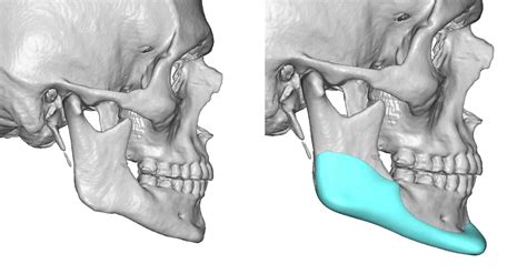 Low Mandibular Plane Angle Jawline Implanty design side view Dr Barry ...