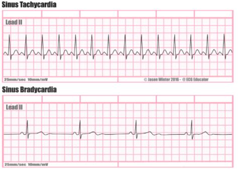 Physiological Mechanisms Of Arrhythmia Flashcards Quizlet