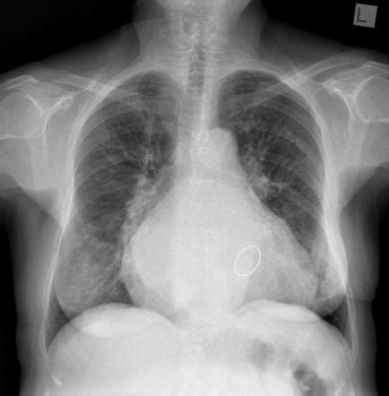 Double Density Sign Left Atrial Enlargement Radiology Reference