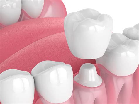 What Are The Pros And Cons Of Dental Crowns