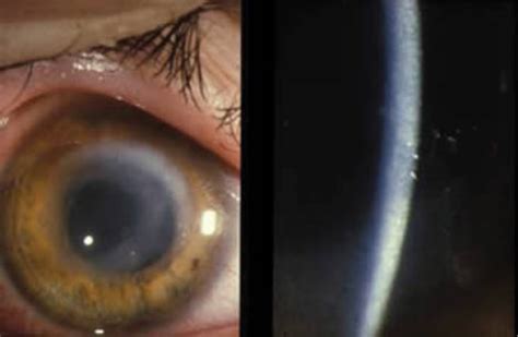 Acanthamoeba Keratitis Ring Infiltrate