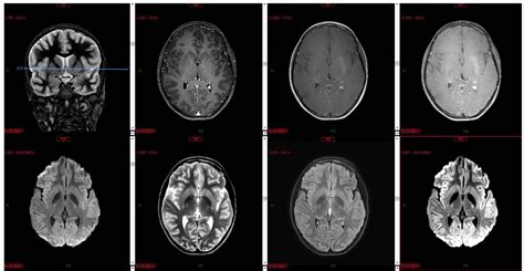 Frontiers Delayed Neuropsychiatric Sequel Following Pediatric Carbon