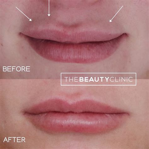 Filler Migration And Reversal The Beauty Clinic