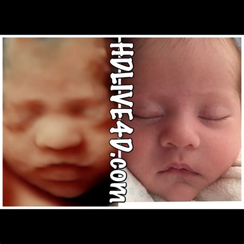 Before And After Photo Gallery 5d Hdlive™ 3d 4d Hd Ultrasound Virginia