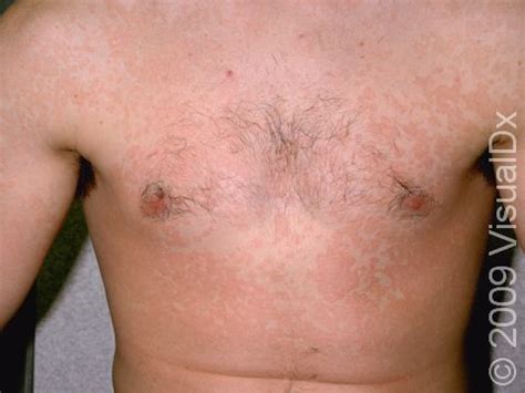 What Is Tinea Versicolor Symptoms Causes Diagnosis 44 OFF