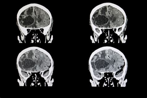 Metastatic Brain Tumor Pictures