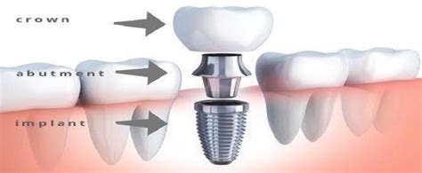 Porcelain Vs Composite Veneers Advantages And Disadvantages AtoAllinks