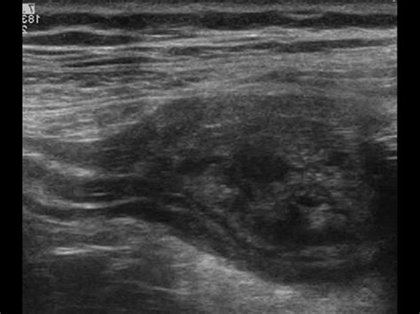 Cystadenoma Or Mucocele Of Appendix Ultrasound Diagnostic Medical