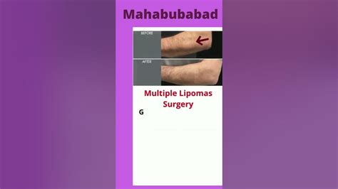 Multiple Lipomas Treatment And Surgery Hospital In Mahabubabad Causes