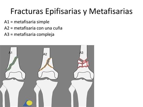 Ppt Tratamiento De Las Fracturas Powerpoint Presentation Free