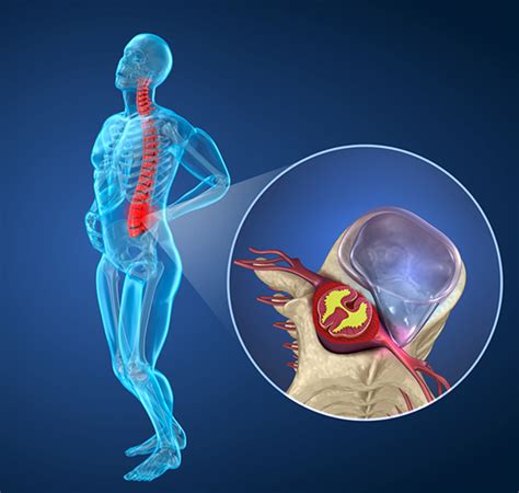 Lumbar Radiculopathy The Orthopedic Pain Institute Beverly Hills