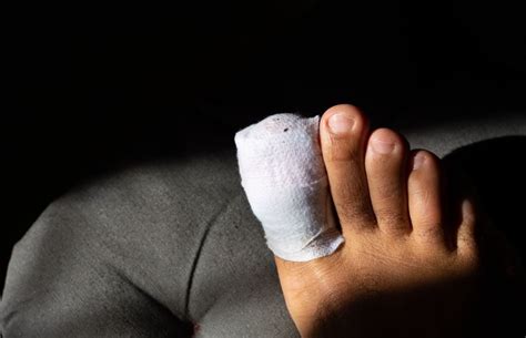 Surgery Options For A Recurring Digital Mucous Cyst On Toe