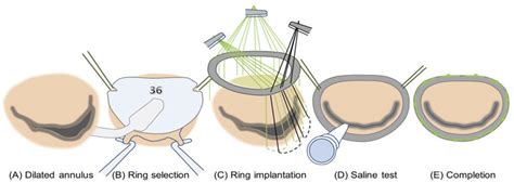 Schematics of the standard clinical guideline of ring annuloplasty ...