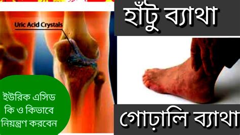 ইউরিক এসিড কি ও এর প্রতিকার What Is Uric Acid Youtube