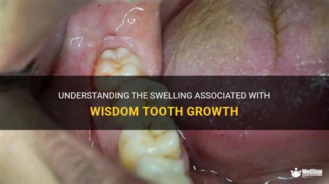 Understanding The Swelling Associated With Wisdom Tooth Growth Medshun