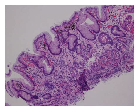 Gastric mucosa with inactive chronic gastritis, foveolar hyperplasia ...