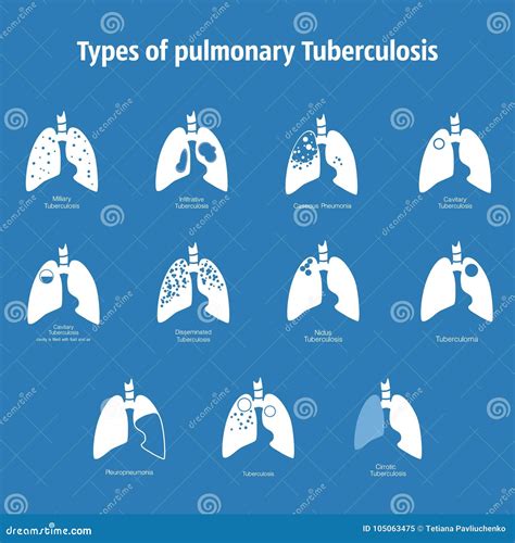 Types Of Tuberculosis Cartoon Vector CartoonDealer 131836299