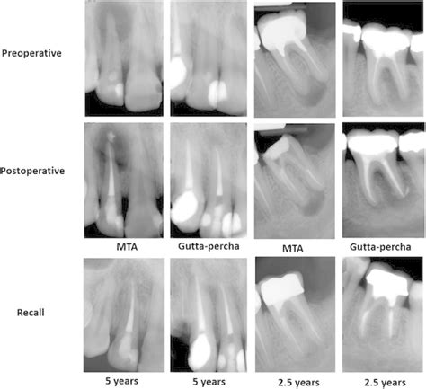 Periapical Radiographs Of Primary Treatment In Maxillary Lateral