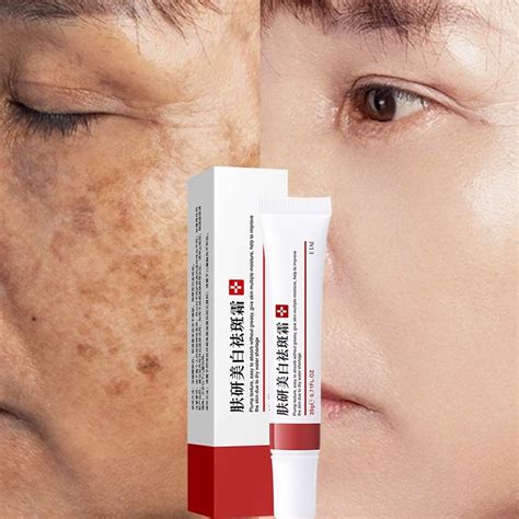 Whitening Freckle Removing Cream Remove Dark Spots Fade Acne Scars