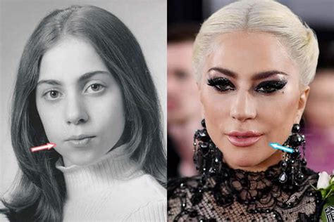 Does Lady Gaga Have Plastic Surgery Before After 2018