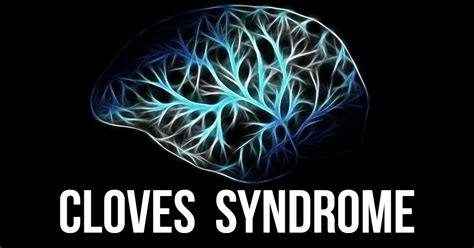 Take The Free Online Learn More About Cloves Syndrome Science Quiz