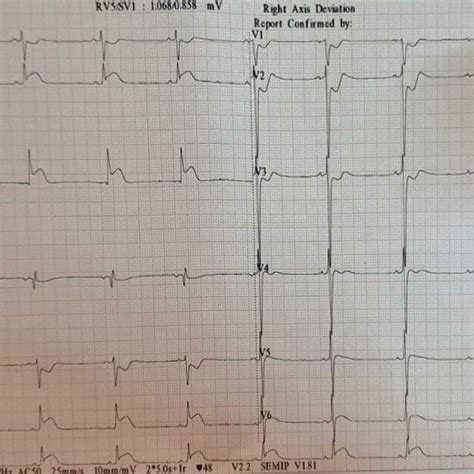 Ecg Showing St Elevation In The Inferior Leads Ii Iii Avf While St Download Scientific