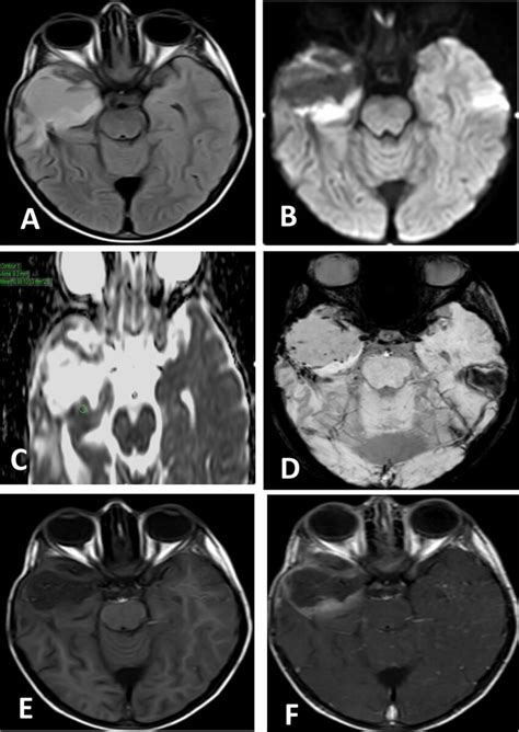 Twelve Year Old Female Children Presenting With Anaplastic Astrocytoma