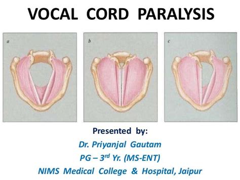 Vocal cord paralysis | Paralysis, Vocal, Voice therapy