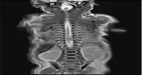 Disseminating MSSA Infection in a Preterm Infant With Rare F... : Advances in Neonatal Care