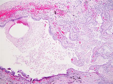 Pulmonary Mucinous Cystadenocarcinoma An Unusual Presentation And Literature Review Bmj Case