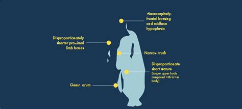 What Causes Achondroplasia Fgfr3 Gene Mutation