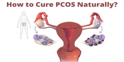 Cure Pcos Naturally 7 Best Ways Healthmania