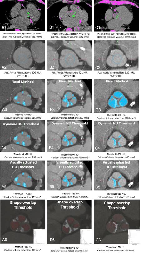 Validation Of Aortic Valve Computed Tomography Calcium