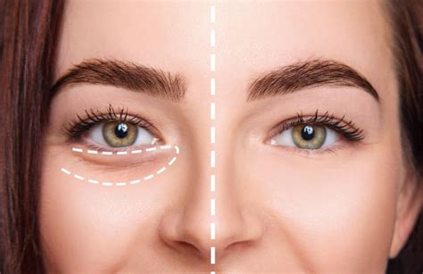 The Ultimate Guide To Juvederm Under Eyes Everything You Need To Know Reuterings