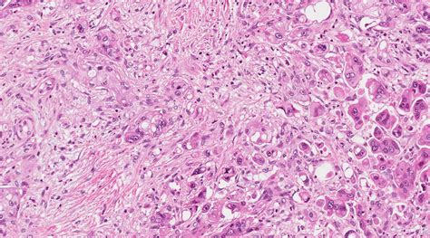 Pathology Outlines Undifferentiated Carcinoma