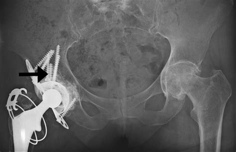 Reconstruction Of Massive Uncontained Acetabular Defects Using Allograft With Cage Or Ring