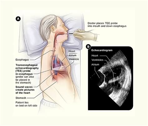 What To Expect During Echocardiography Storymd