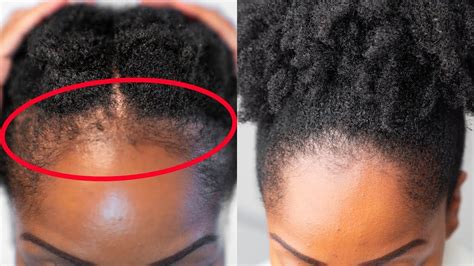 GROW Back Your EDGES FAST With These 5 SIMPLE Tips Edges Hair Hair