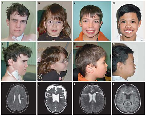 Chromosomal Deletion Syndrome