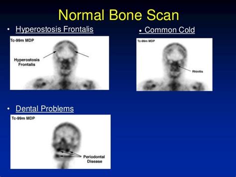 Bone Scan