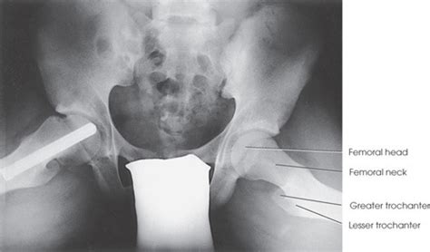 Ch Pelvis And Hip Flashcards Quizlet