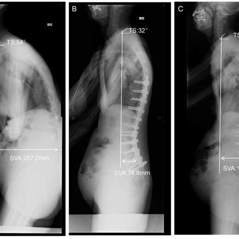 Radiographs Of The Patient In The L Group A 71 Year Old Female Patient