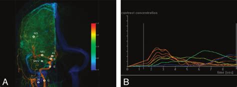 A Ap View Of Color Coded Right Carotid Artery Dsa Of A Control