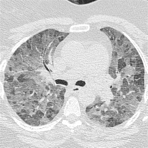 Bronchiolitis A Practical Approach For The General Radiologist