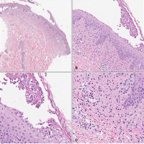 Diffuse Erythematous Eruption With Nonfollicular Pinhead Sized Pustules