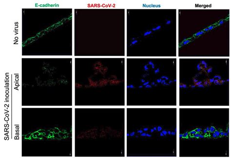 Michael Patmas, MD, FACP on LinkedIn: Preferential Apical Infection of ... 