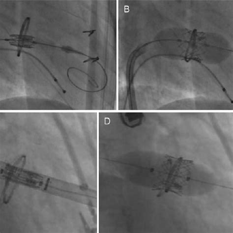 Multimodality Imaging After Transcatheter Mitral Valve In A Ring