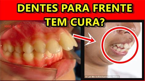 Dentes Muito Para Frente Como Corrigir Youtube